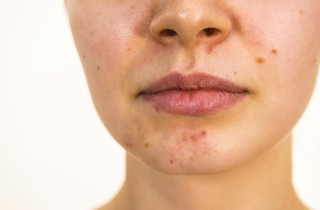 Perché hai l’acne sul mento e come si cura?