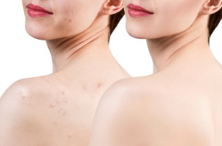 5 modi per prevenire l’acne sul corpo