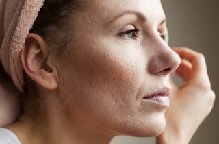 2 trattamenti che funzionano davvero contro l’acne