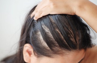 Perdita dei capelli frontale: che cos’è e da che cosa dipende?