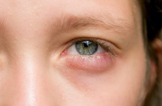 Occhio gonfio: cause e rimedi naturali migliori