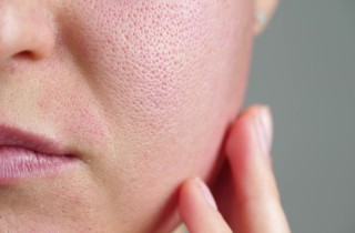 6 consigli per ridurre i pori dilatati
