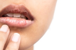 Labbra screpolate, 5 rimedi che devi assolutamente provare