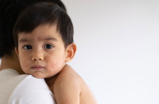 Rosolia nei bambini e in gravidanza:8 cose da sapere