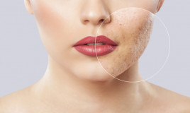 Pelle acne