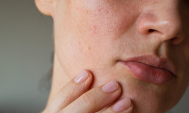 cause dell'acne