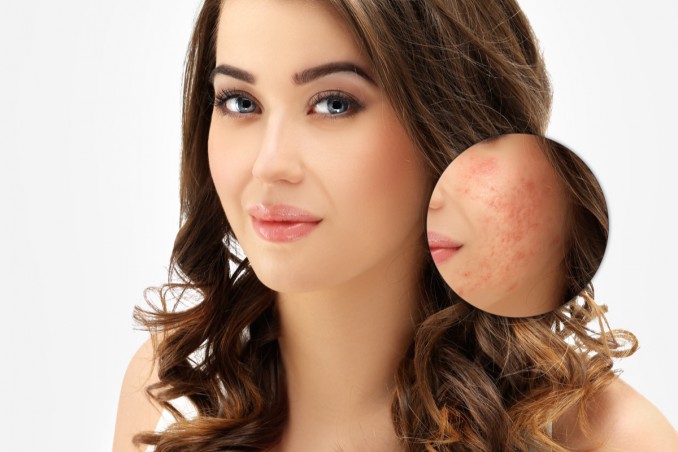 Rimedi Per Cicatrici Acne