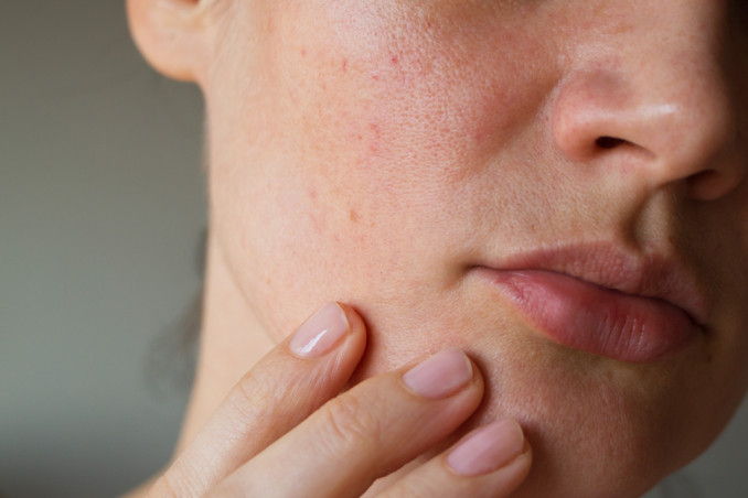 cause dell'acne